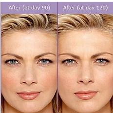 BOTOX® treatment targeting 11 lines between the eyebrows to reduce frown lines and create a smoother, relaxed appearance