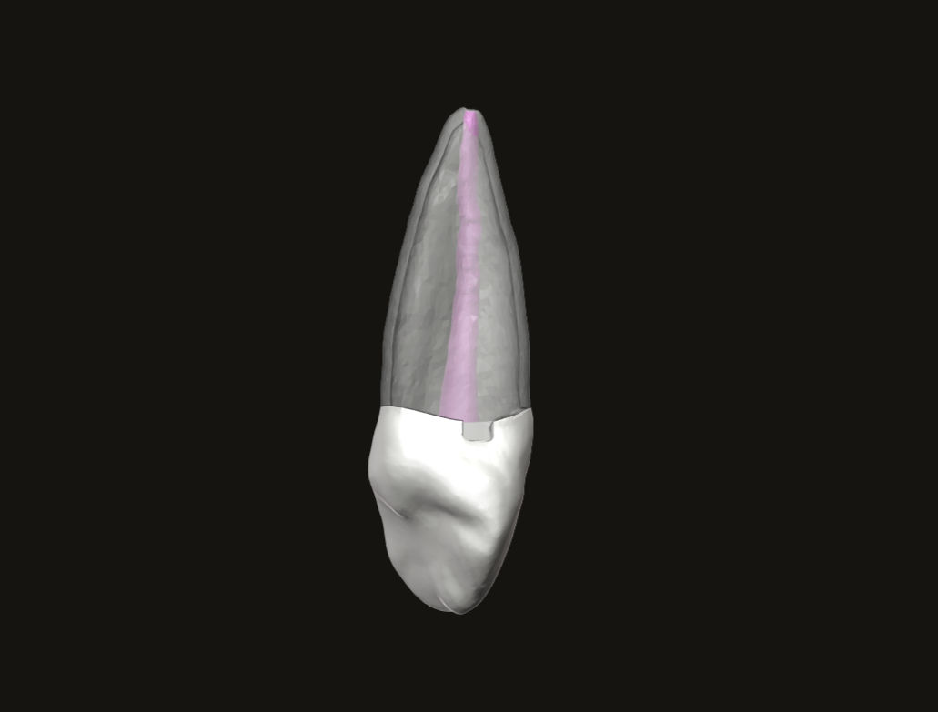 Endo Tooth #13