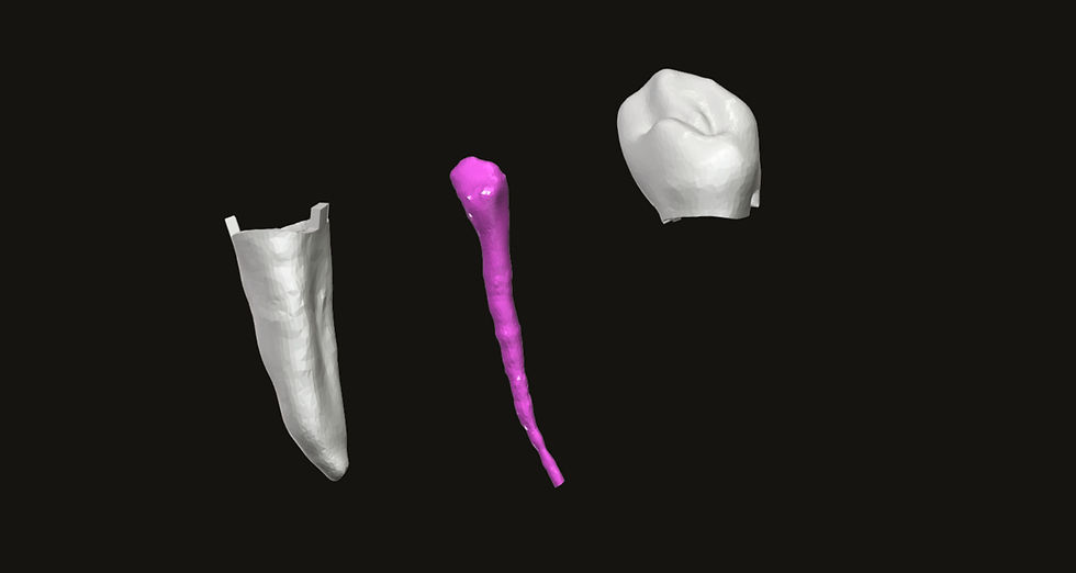 Thumbnail: Endo Tooth #44