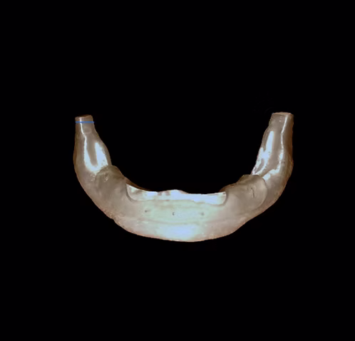 Basic Implant Surgical Guide