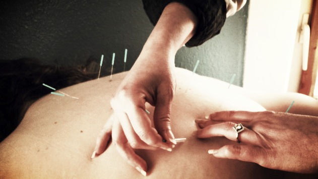 Acupuncture