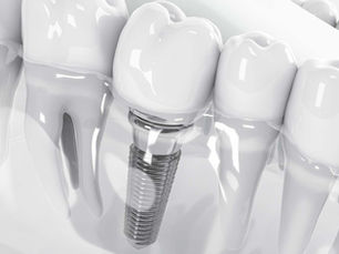 Same Day Dental Implants: A Revolutionary Solution at Jehangir Oracare Dental Centre