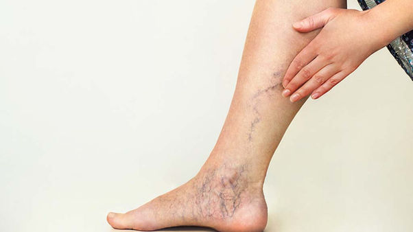 O Fim das Varizes Com a Escleroterapia