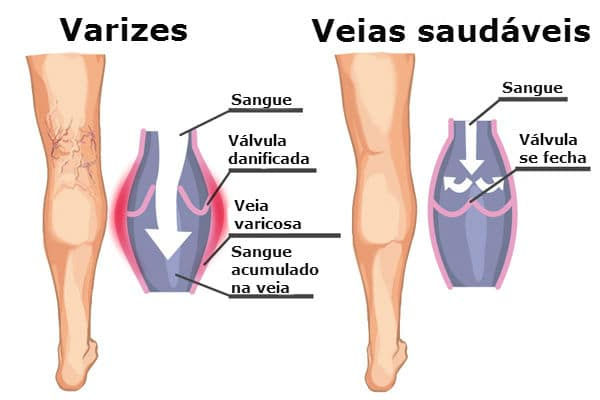 Tratamentos atuais podem substituir a cirurgia em pacientes com varizes