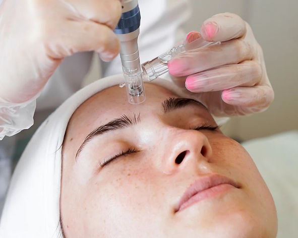 A person undergoing a facial treatment, with a close-up of a technician using a micro-needling device on their forehead