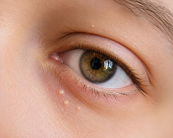 Milia Removal