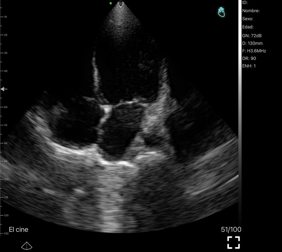 Thumbnail: SONOQUE L4PC - Wireless Portable Ultrasound Probe