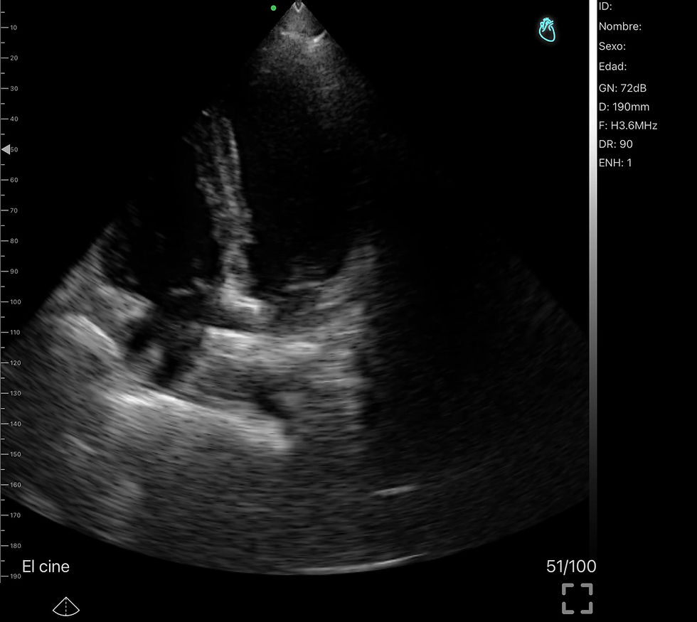 Thumbnail: SONOQUE L4PC - Wireless Portable Ultrasound Probe