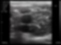 Thumbnail: SONOQUE L5 - Wireless Handheld Ultrasound Probe