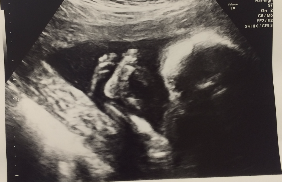 Ultrasound scan image of a baby at 20 weeks gestation in a frank breech presenting position. Legs are crossed and feet are straight up in front of baby's head.