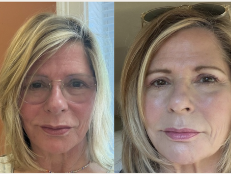 Prep for my 50 HS Reunion... begins with Collagen Induction Therapy - Angie