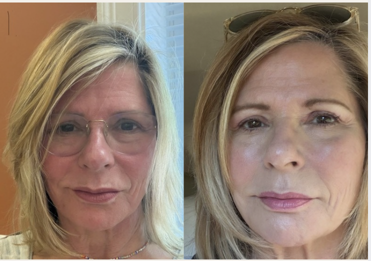 Prep for my 50 HS Reunion... begins with Collagen Induction Therapy - Angie