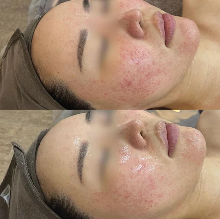 Basic Barrier Balance results after 1 treatment. Results achieved with the full recommended skincare regimen.