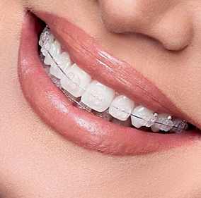 sorriso com o aparelho estético