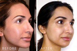 fraxel-treatment-before-after