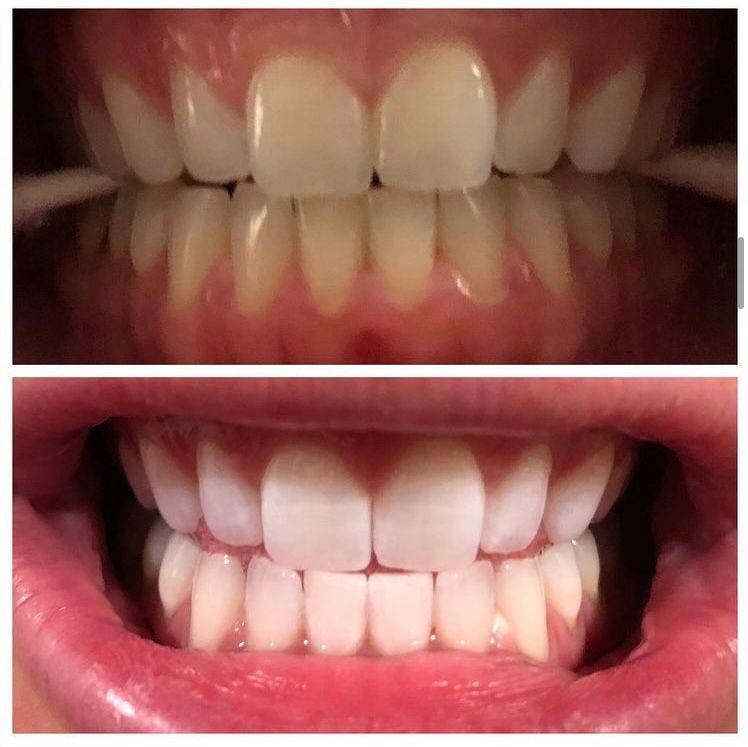 Thumbnail: AT HOME BE-YOU TEETHFUL WHITENING KIT