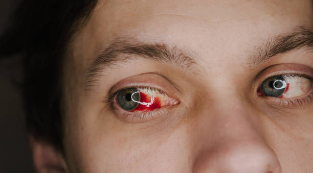 Hemorragia subconjuntival