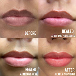 Lip Neutralization - Before and After