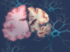 Alzheimer’s Disease and Amyloid Plaques