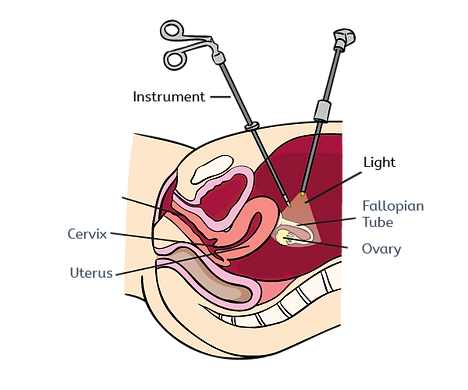 Laparoscopy.png