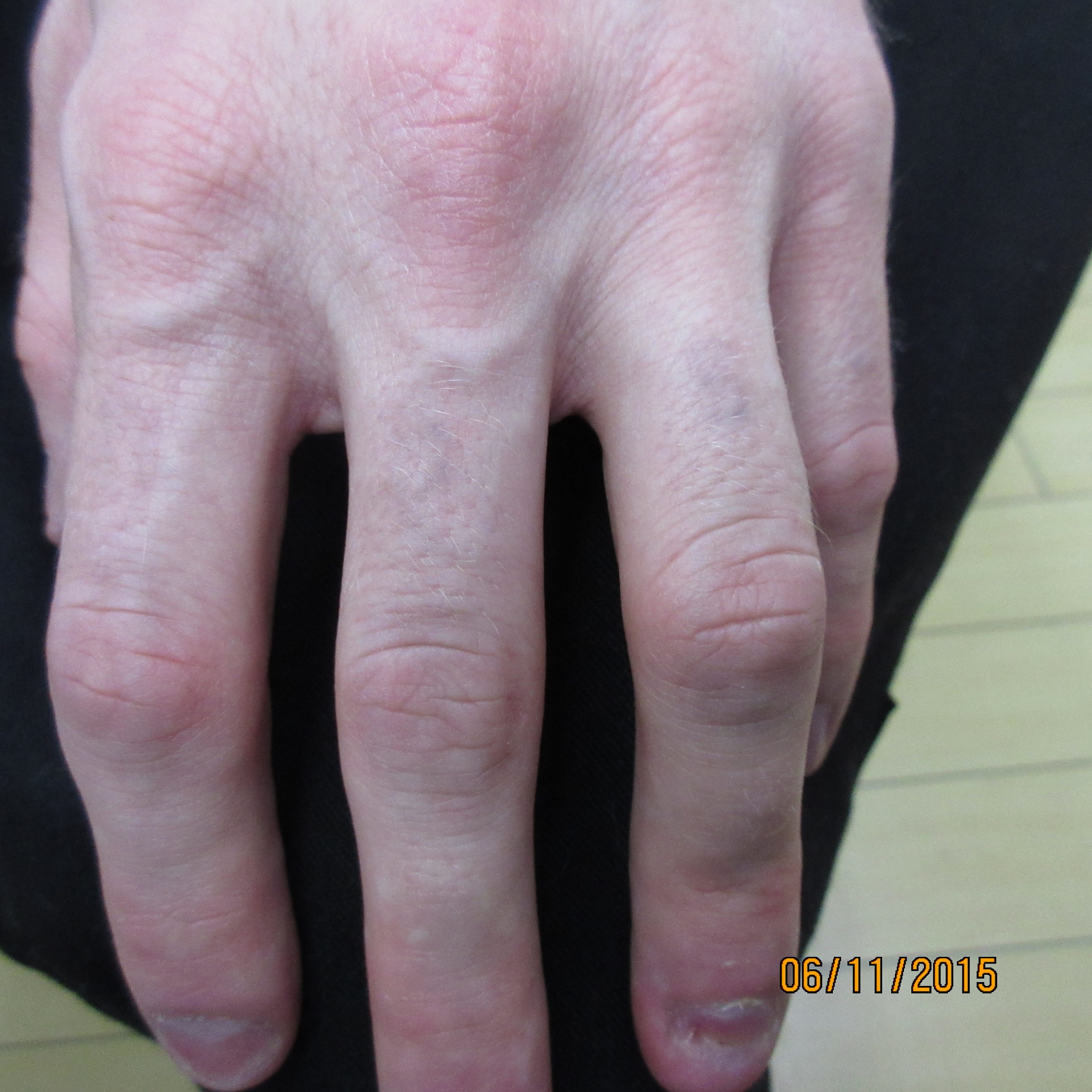 Knuckles