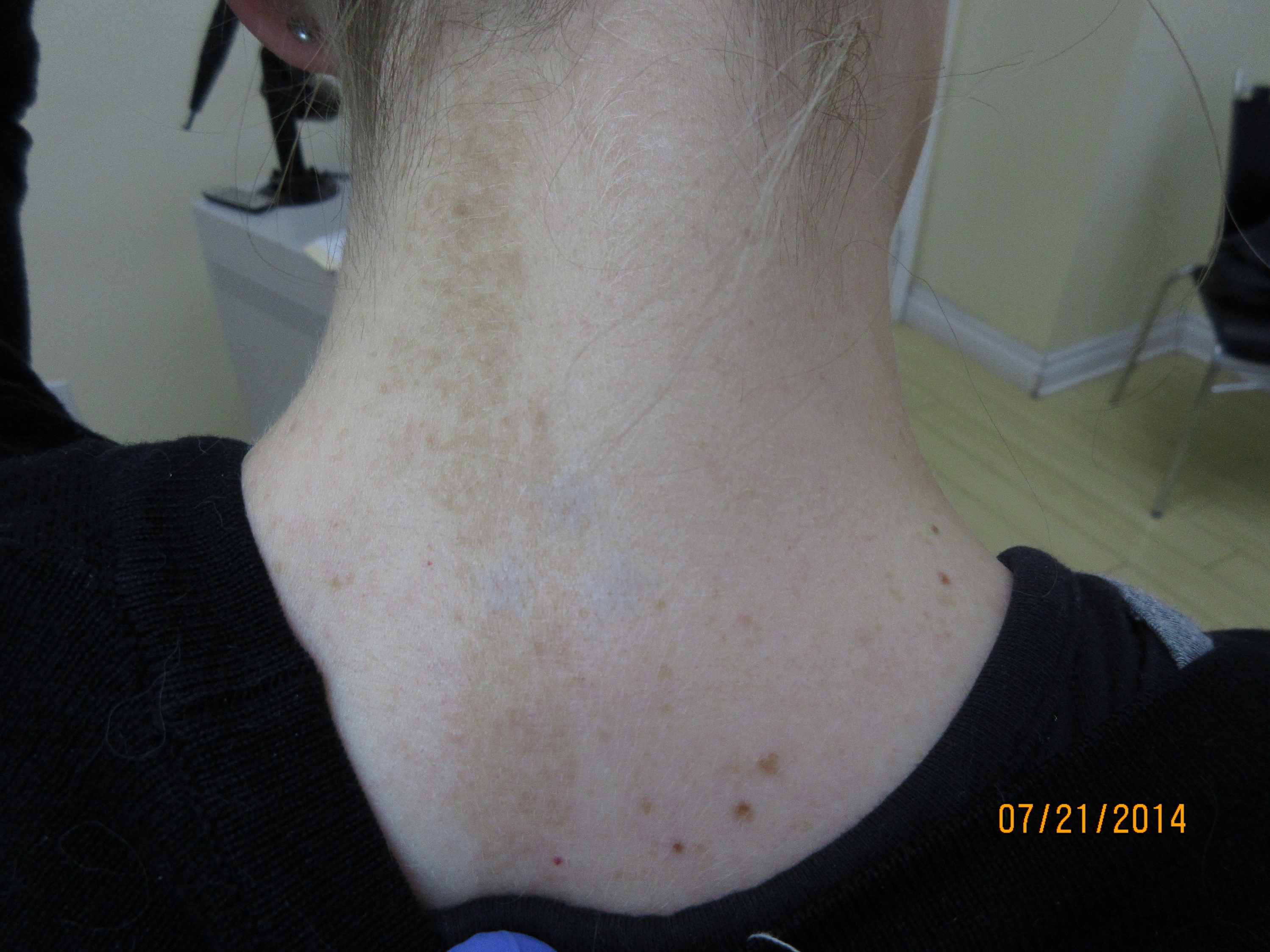 Back Of Neck