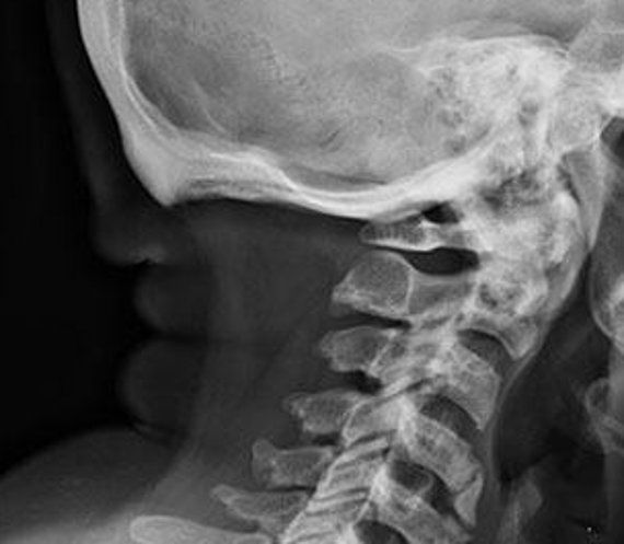 hernie-cervicale-tout-savoir-1_2.jpg