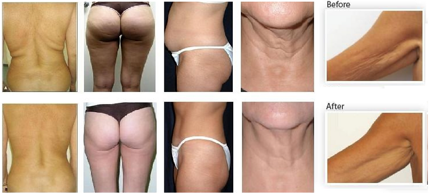 Ultrasonic Cavitation Fat Removal Results