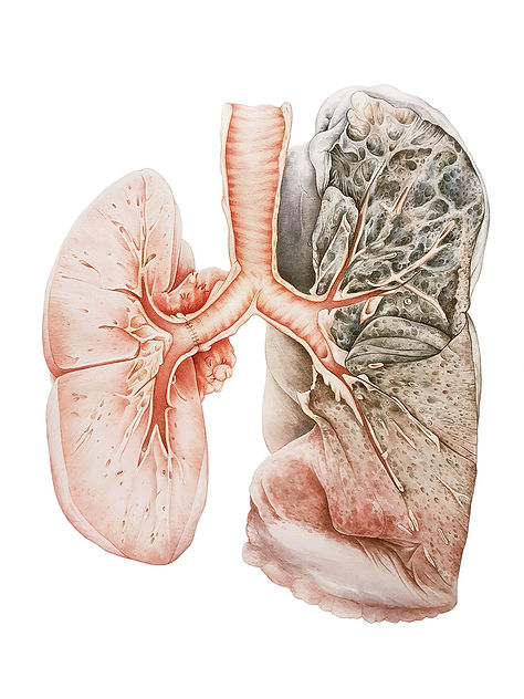 pathology lungs - maria socias.jpg