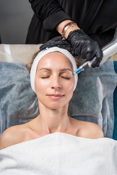 Woman getting microneedling therapy on face for skin health and beauty
