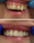 Gadent-bonding-nowe-zeby