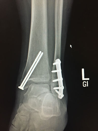 ankle fracture