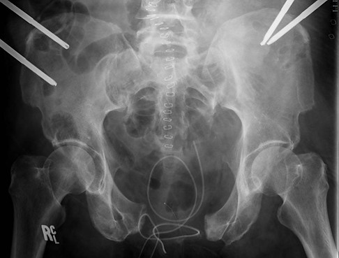 pelvic fracture