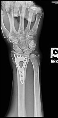 fixed wrist