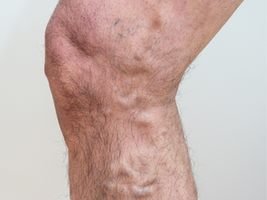 Varises dan penyebabnya