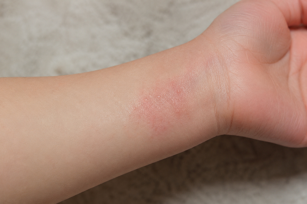 A small rash on wrist of child with eczema atopic dermatitis