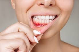 Gum Disease Treatment in Old Bridge, NJ - Bond Dental Studios