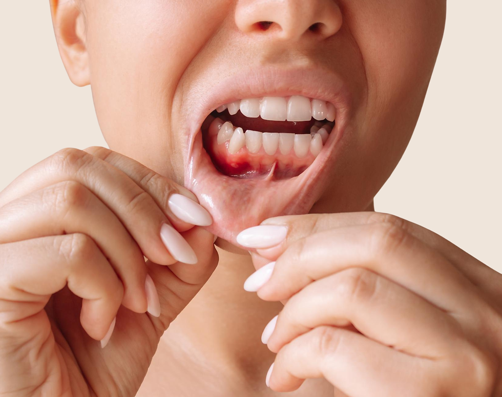 Traitement des gencives à Paris – Cabinet Dentaire Paris Marcadet