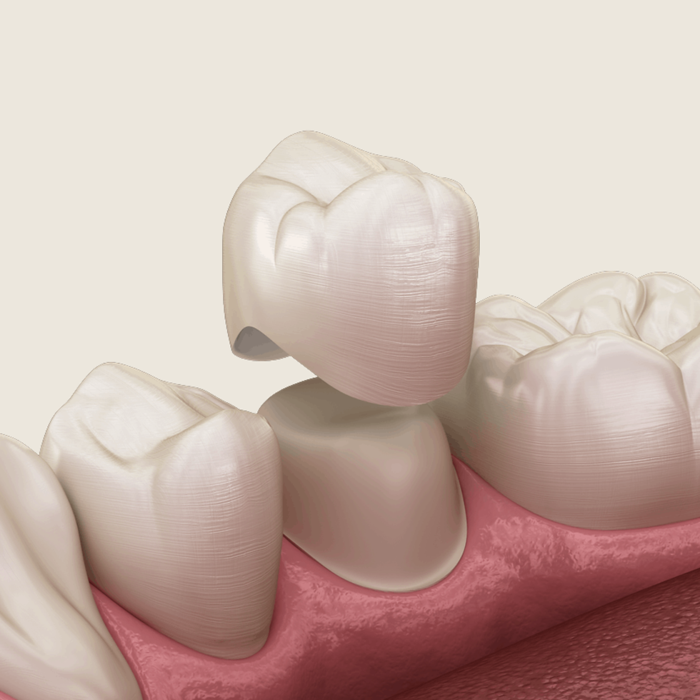 Same-Day Dental Crowns in San Diego, CA - Rancho Bernardo Dental Arts 