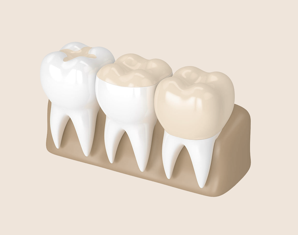 Inlays & Onlays à Paris – Cabinet Dentaire Paris Marcadet