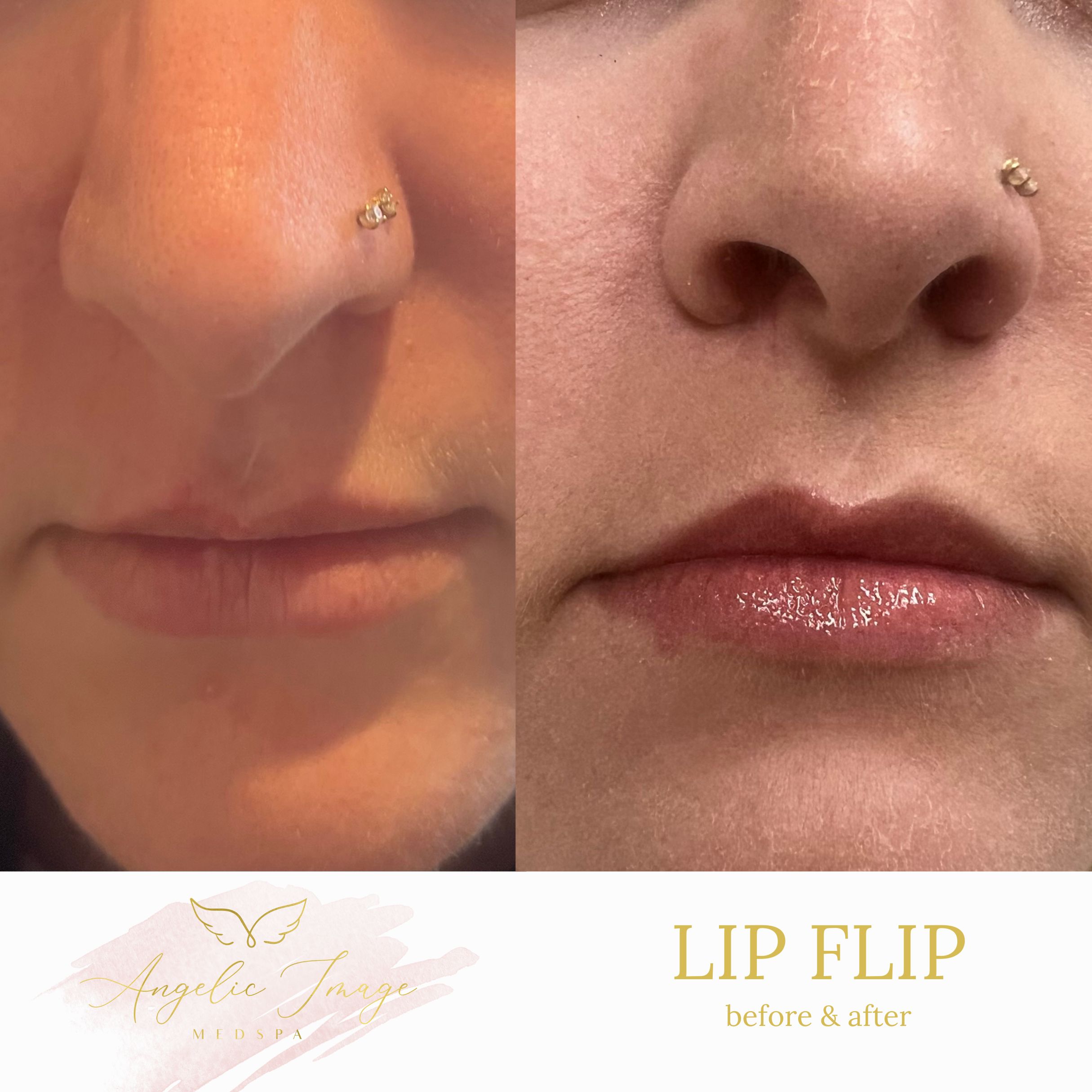 Angelic Image Medspa before and after