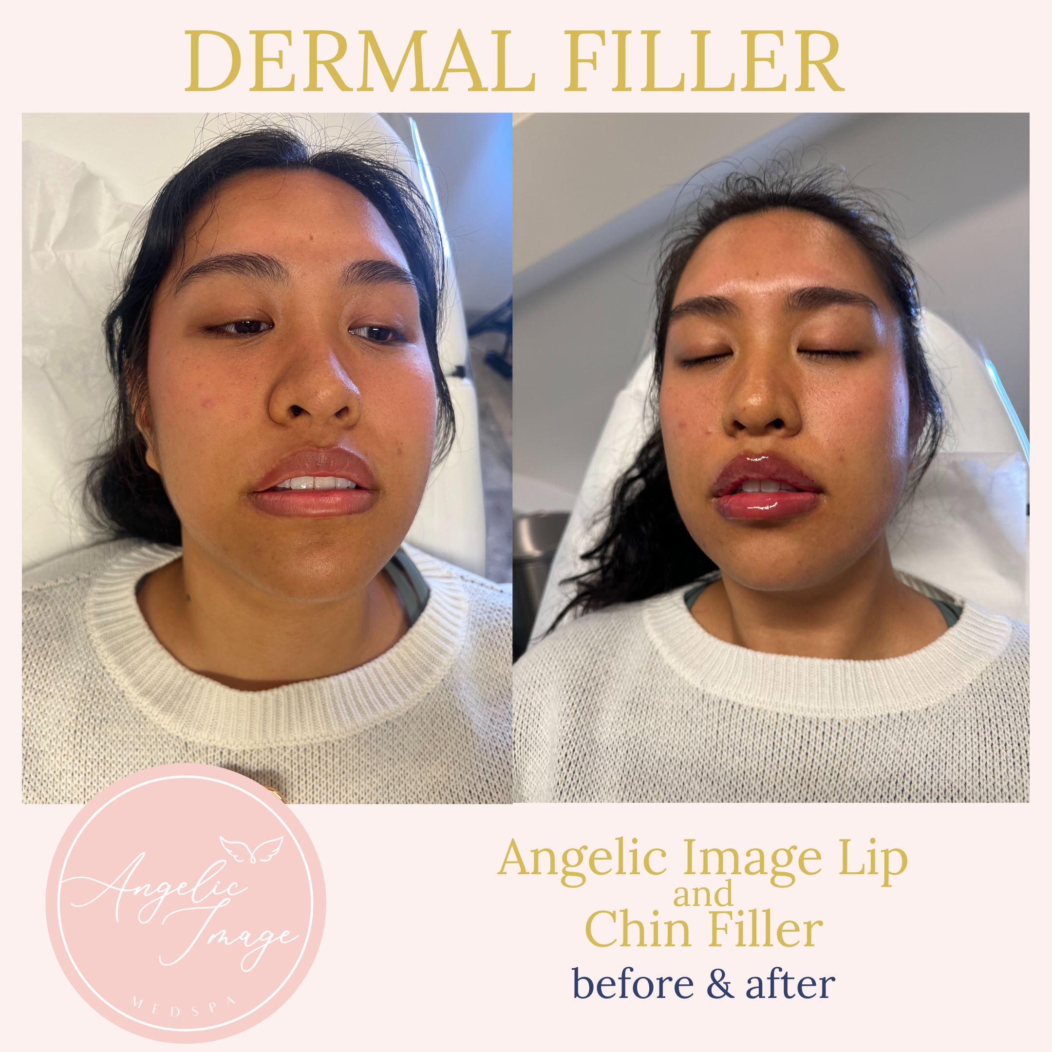 Angelic Image Medspa before and after