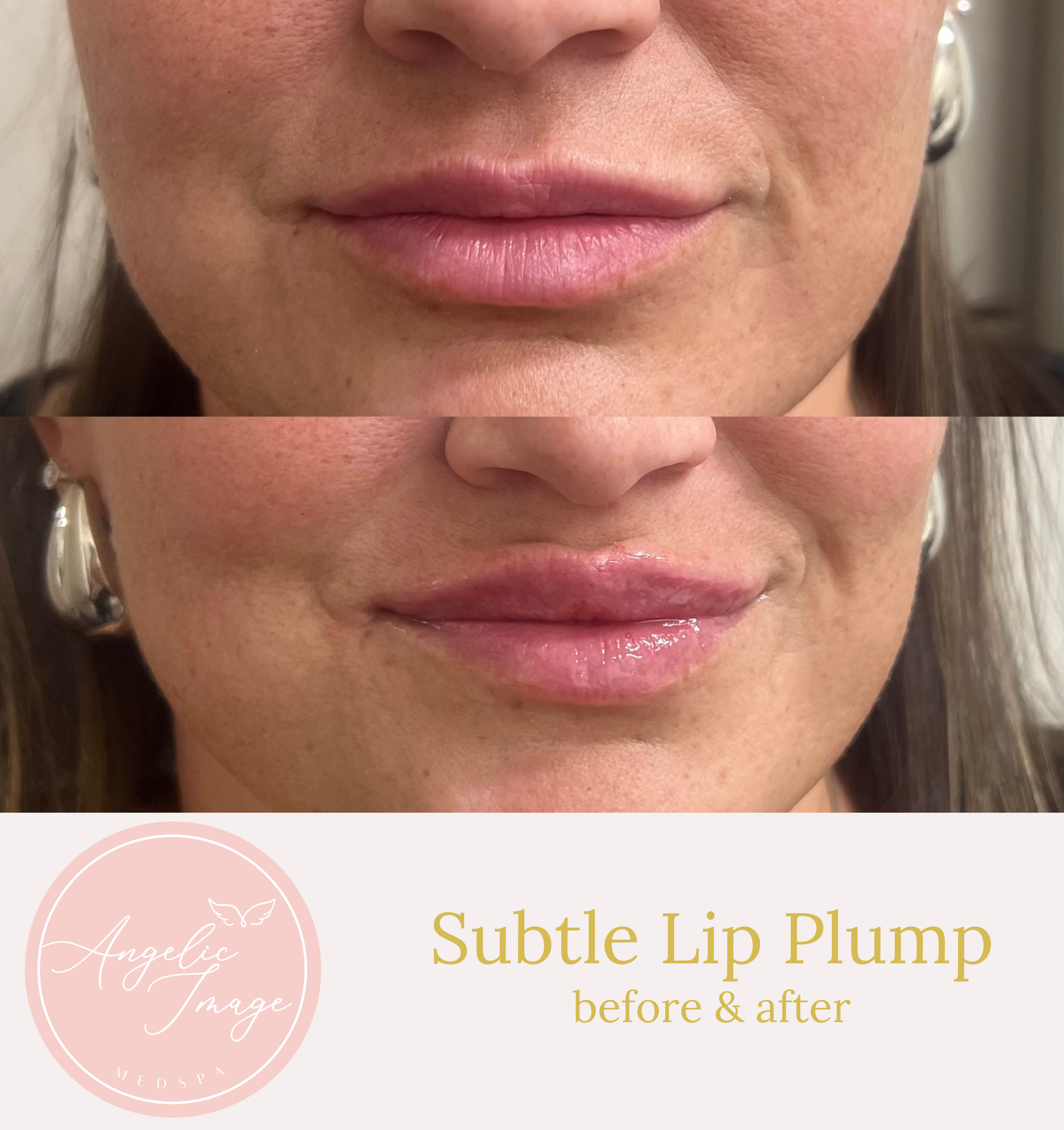 Angelic Image Medspa before and after