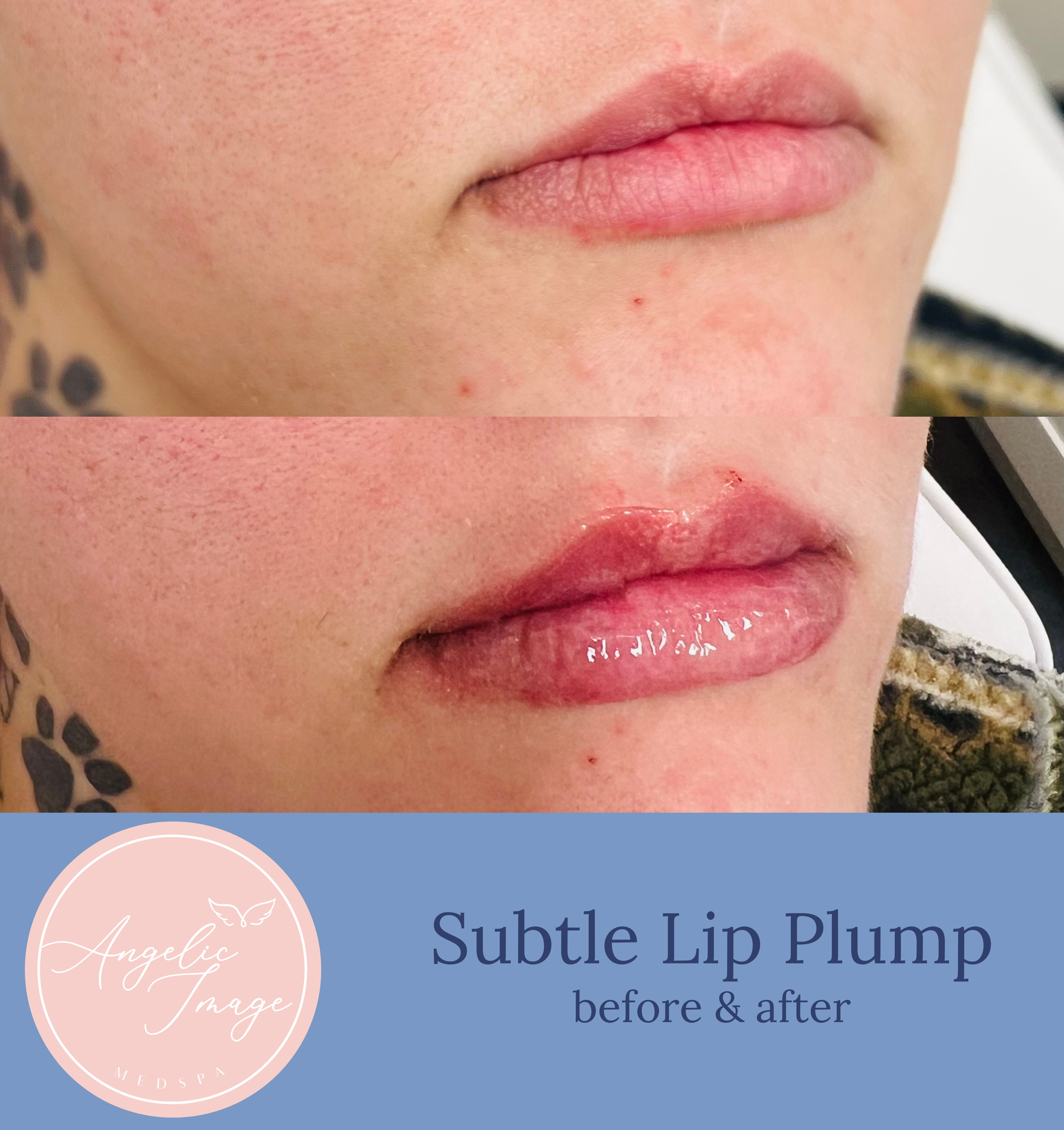 Angelic Image Medspa before and after