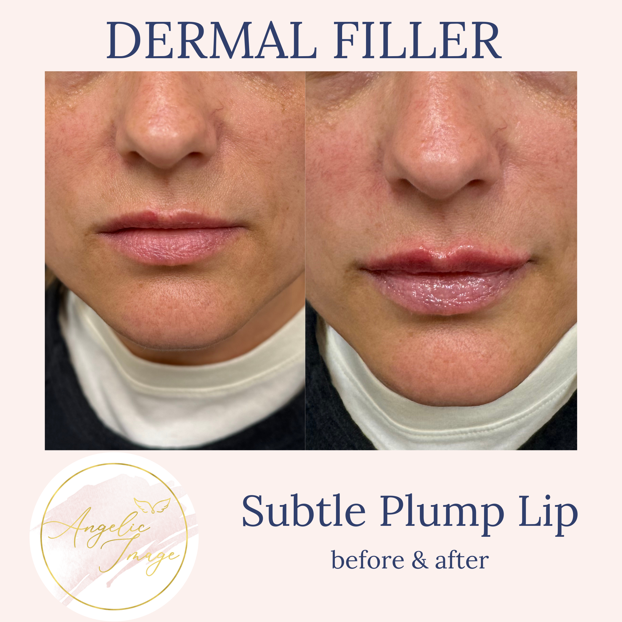 Angelic Image Medspa before and after