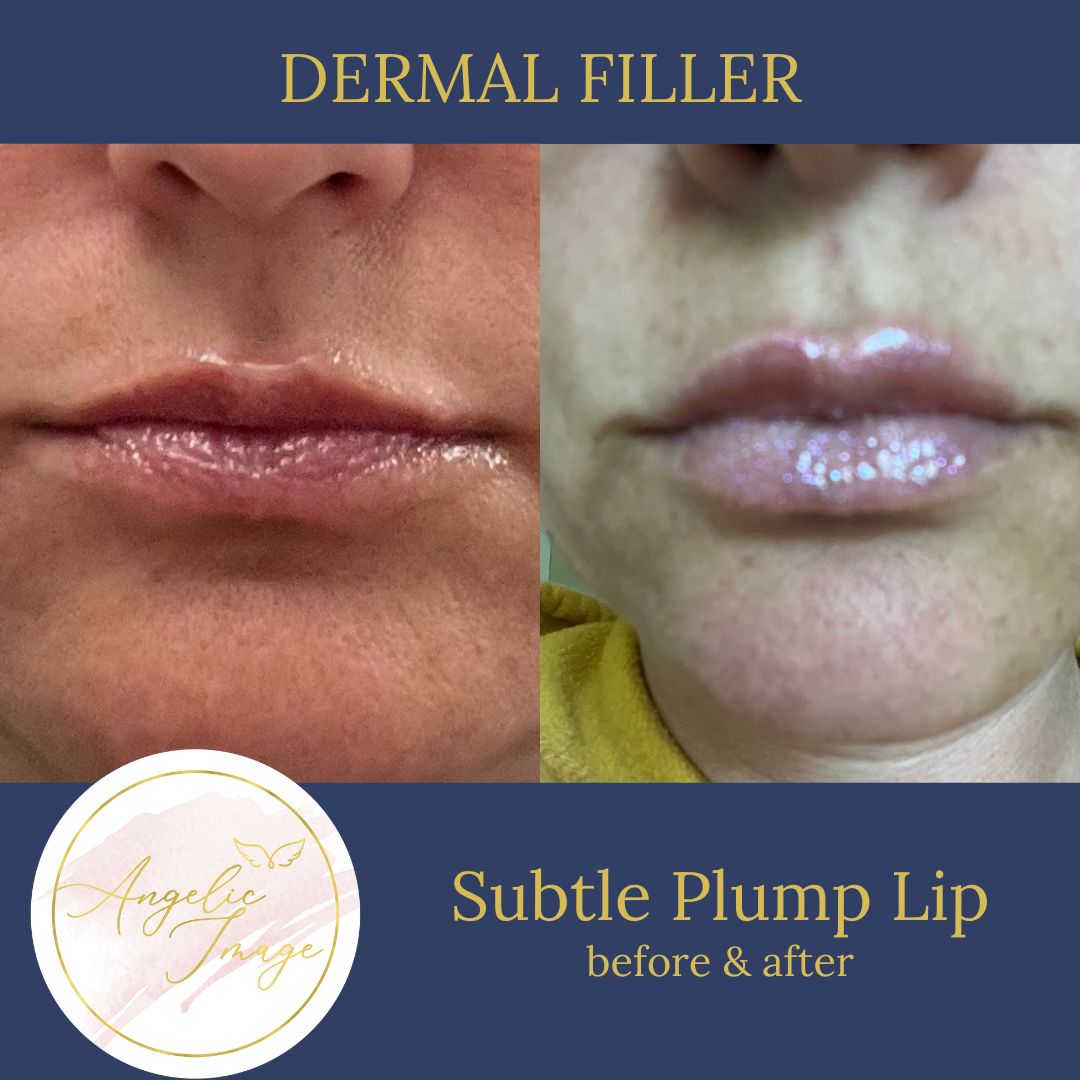 Angelic Image Medspa before and after