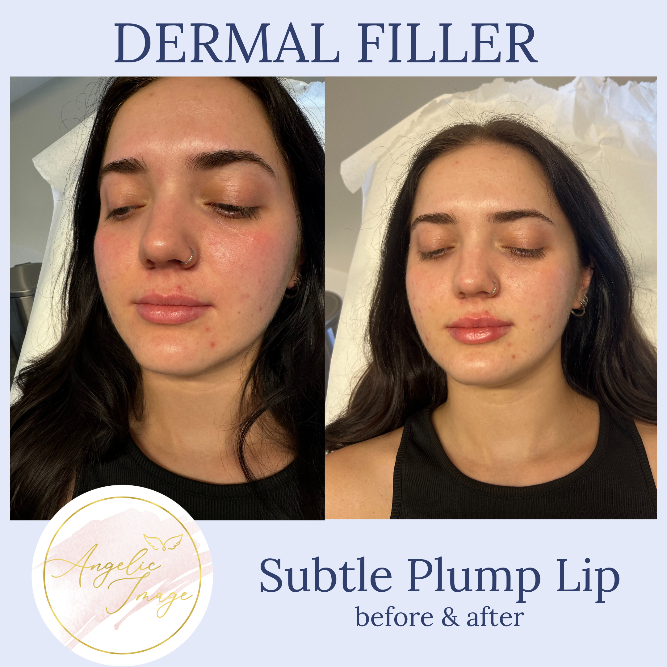 Angelic Image Medspa before and after