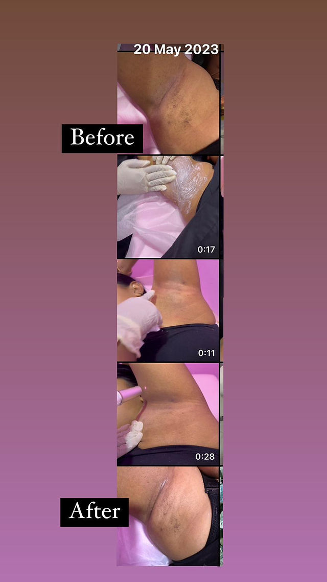 underarm whitening singapore