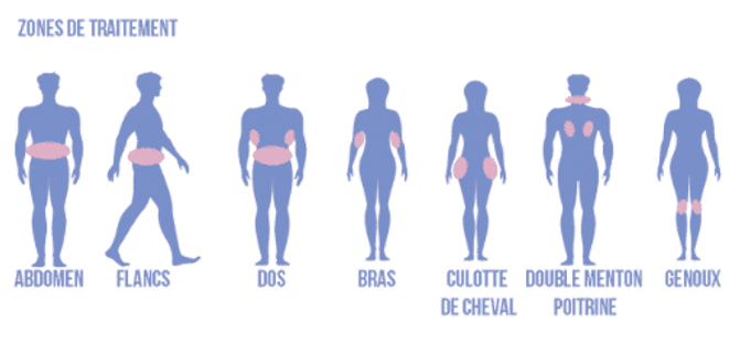 zones-de-traitement-cryolipolyse.png