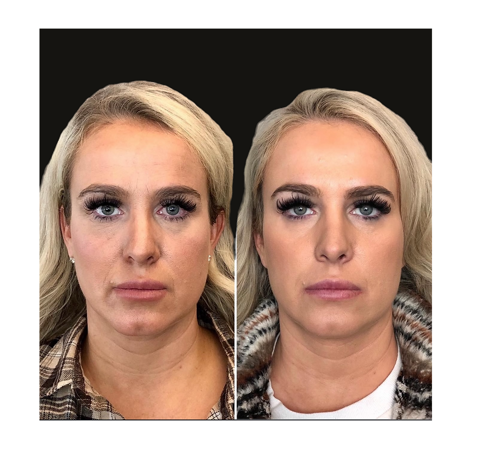 Wrinkle Relaxers Before & After_edited